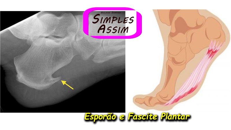 Esporão e Fascite Plantar - Programa Simples Assim